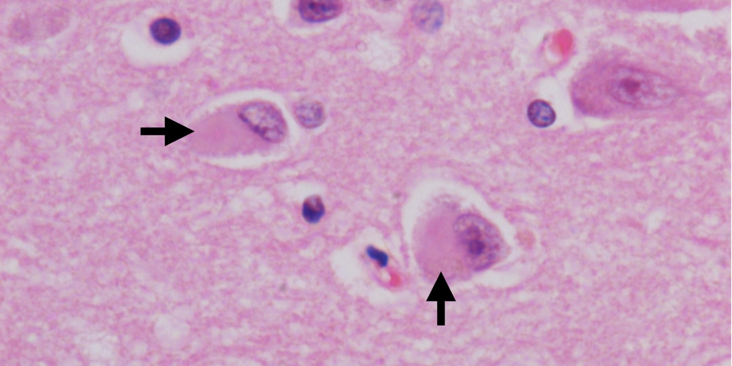 Dementia with Lewy bodies under the microscope 